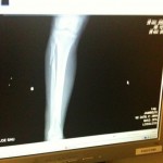 tibia-perone tibia-perone