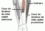 Périostite tibiale ou douleur au tibia : une solution