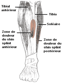 Périostite tibiale ou douleur au tibia : une solution