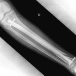 fracture du tibia et du péroné 