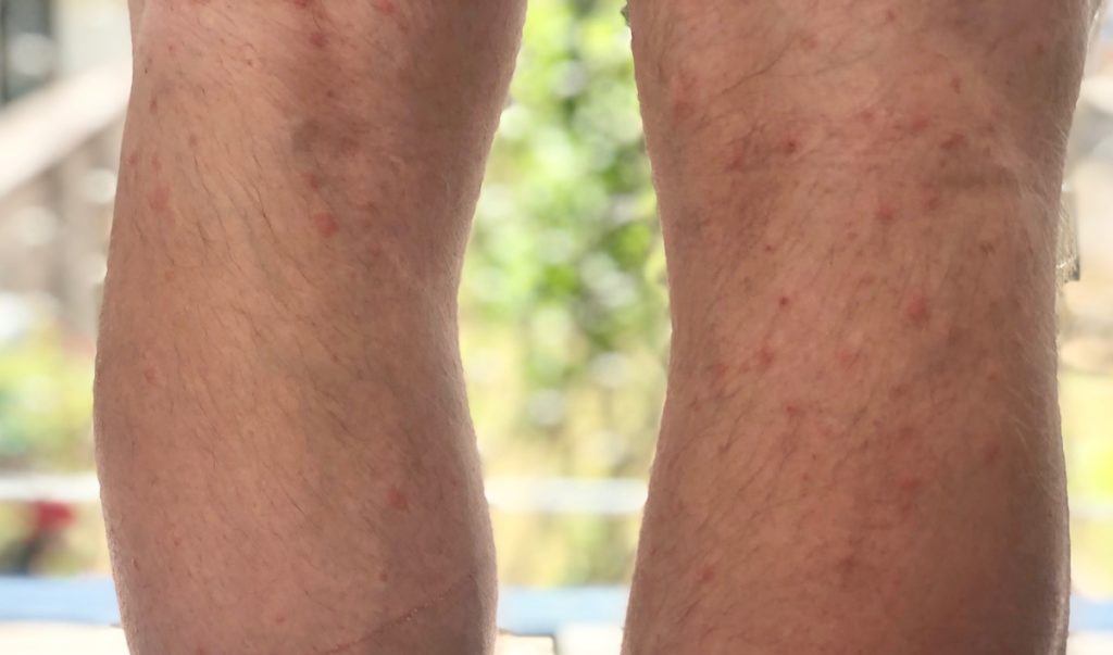Coureurs, cyclistes : points rouges sur les jambes